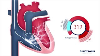 What is an Implantable Cardioverter Defibrillator ICD [upl. by Mellisent]