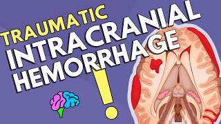 Intracranial Hemorrhage [upl. by Palua]