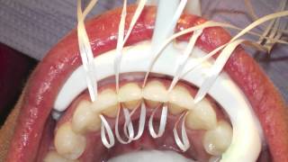 Retanium Splint Placement Orthodontics [upl. by Tien]