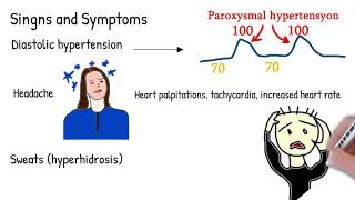 Pheochromocytoma amp Paraganglioma What Every Endocrinologist amp Physician Needs to Know [upl. by Felicdad295]