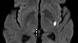 Acute lacunar infarction basal ganglia [upl. by Flory]