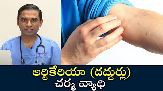 Urticaria skin disease  Samayam Telugu [upl. by Nylknarf]