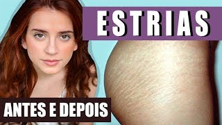 TCHAU ESTRIAS BRANCAS FUNCIONA Antes e Depois [upl. by Luaped657]