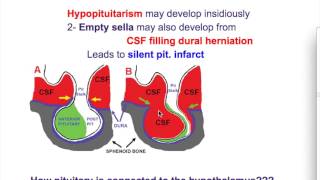 kallmann syndromeEmpty Sella syndrome [upl. by Genovera120]