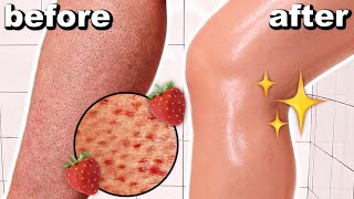 HOW TO GET RID OF STRAWBERRY LEGS IN ONE DAY Get Rid Of Keratosis Pilaris And Dark Spots On Legs [upl. by Idalla]