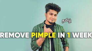 HOW TO REMOVE PIMPLE PERMANENTLY  IN TAMIL  SARAN LIFESTYLE [upl. by Gothart]