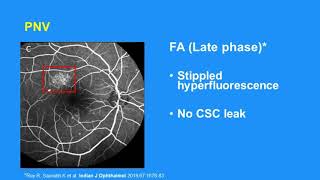 PNV Pachychoroid Neovasculopathy [upl. by Rebane833]