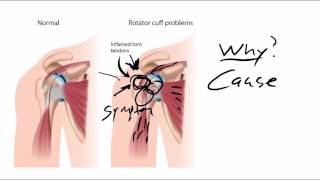 Peroneal Tendonitis  Home Stretches and Exercise Rehabilitation Plan [upl. by Gascony]