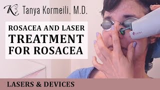 Rosacea and laser treatment for rosacea [upl. by Kwabena]