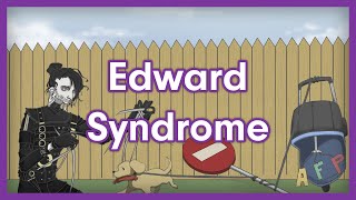 Edward Syndrome Trisomy 18  USMLE Step 1 Mnemonic [upl. by Alexandr]