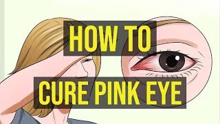 How To Cure Pink Eye Fast  5 Quick Ways [upl. by Hgielah]