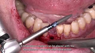 Dr Stefan P Hicklin Straumann® BLT Ø 29 mm implant [upl. by Etnoed]