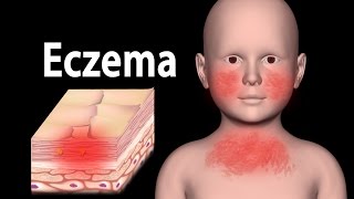 Eczema Animation [upl. by Arob]