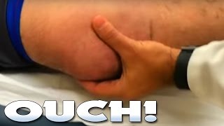 How to Treat a Dislocated Shoulder [upl. by Comptom]