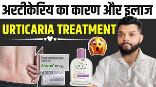 Urticaria Causes Symptoms amp Allopathic Treatment In Hindi  Skin Allergy In Hindi [upl. by Tsai178]