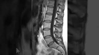 Jaccoud’s Arthropathy [upl. by Ahsietal]