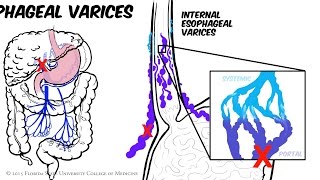 Portal Hypertension Animated Review [upl. by Isabelle]