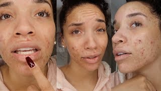 My Accutane Experience  First Week  Acne Update 3 [upl. by Delastre]