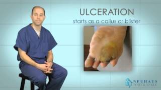 Diabetic Ulcerations and Amputations [upl. by Corabelle]