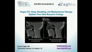 TongueTie Sleep Breathing and Myofunctional Therapy New Research Updates Dr Zaghi at ALSC 20 [upl. by Papagena]