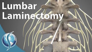 Lumbar Laminectomy [upl. by Ahsetan413]