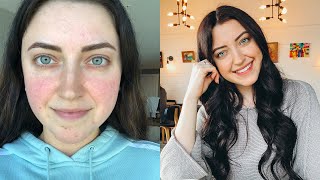 Treating Rosacea my IPL experience [upl. by Gretchen905]