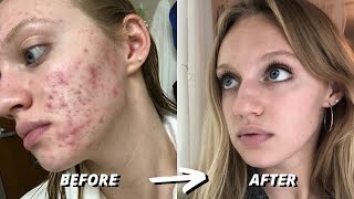 HOW I CLEARED 7 YEARS OF SEVERE ACNE  ACCUTANE JOURNEY [upl. by Natala]