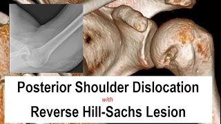 Posterior Shoulder Dislocation Reduction [upl. by Attennod]