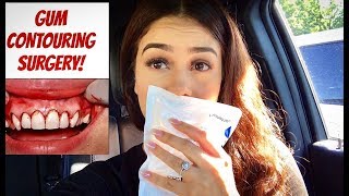 Gum Contouring SurgeryProcedure Vlog  My Experience [upl. by Stephi]