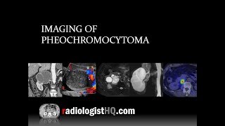 Pheochromocytoma Causes Findings Diagnosis Treatment [upl. by Graig]