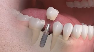 Straumann  Implantatgetragener Einzelzahnersatz [upl. by Analihp135]