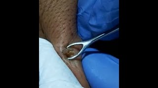 LARGE DEEP BLACKHEAD on back squeezed out Original ASMR [upl. by Erinn]