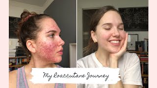 Roaccutane  My 6 Month Journey to Clear Skin [upl. by Doersten135]