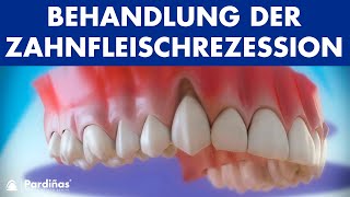 Zahnfleischrückgang – Behandlung der Zahnfleischrezession © [upl. by Wheelwright575]