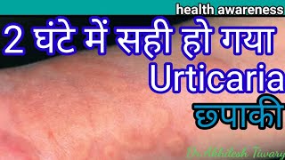 2 घंटे में सही हो गया urticaria शित्तपित्ती।Ayurvedic treatment of urticaria।DrAkhilesh Tiwari [upl. by Gnak]