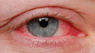 The Basics Pinkeye Causes and Treatments [upl. by Gadmon]