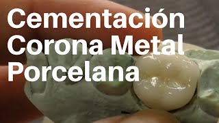 CORONA 👅 METAL PORCELANA Cementación coronadental [upl. by Maryl]