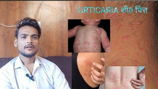 Urticaria पित्ती निकलना [upl. by Mosra199]