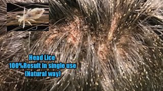 How to get rid of lice eggs in hair permanently in one day naturally with vinegar [upl. by Ahsilrak]