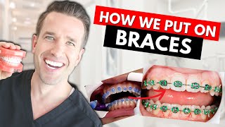 How Braces are Put On  Part IV Dr Nate [upl. by Aiyram356]