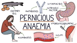 Understanding Pernicious Anaemia B12 Deficiency [upl. by Anyt]