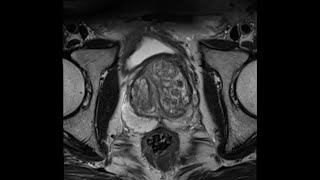 Introduction to Prostate MRI and PIRADS Approach and Principles [upl. by Tracay]