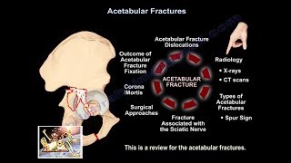 A Review Of Acetabular Fractures  Everything You Need To Know  Dr Nabil Ebraheim [upl. by Adnilra]