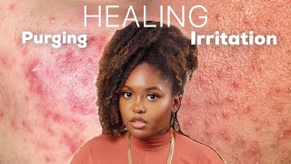 PURGING OR IRRITATION  Esthetician Explains How to Identify and Treat Both Conditions [upl. by Pietrek]