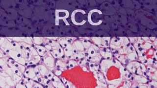 Renal Cell Carcinoma  Pathology mini tutorial [upl. by Judye941]