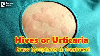 Hives  UrticariaCausesSymptomsTreatment  Skin Rash  Allergy  DrRasya Dixit  Doctors Circle [upl. by Pooi]