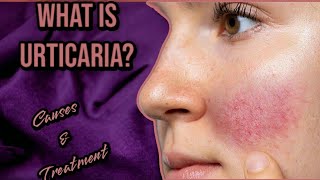 Urticaria  Hives  Causes Symptoms amp Treatment [upl. by Mei380]