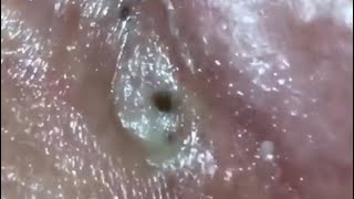 Popping Big Blackheads 😱 [upl. by Hairym]