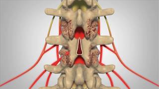 Laminectomy  Patient Education [upl. by Llemhar]