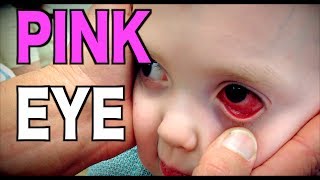 PINK EYE Live Diagnosis Conjunctivitis  Dr Paul [upl. by Christoph]